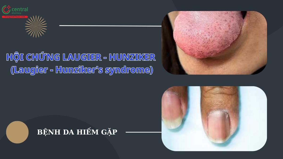 Cách chẩn đoán và điều trị Hội chứng Laugier - Hunziker (Laugier - Hunziker's syndrome)