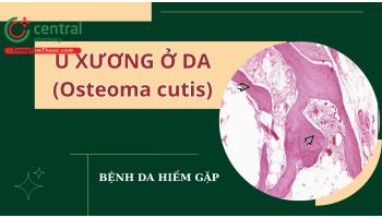 Biểu hiện lâm sàng và cách chẩn đoán bệnh U xương ở da (Osteoma cutis)