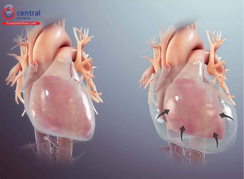 Viêm màng ngoài tim: Chẩn đoán và hướng dẫn điều trị